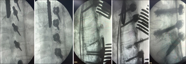 Polymethylmethacrylate augmentation of conventional pedicle screws in spine surgery - A modified classical method.