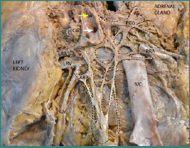The dissection-based identification of the preaortic sympathetic plexus formation, anatomical relations, and clinical applications.