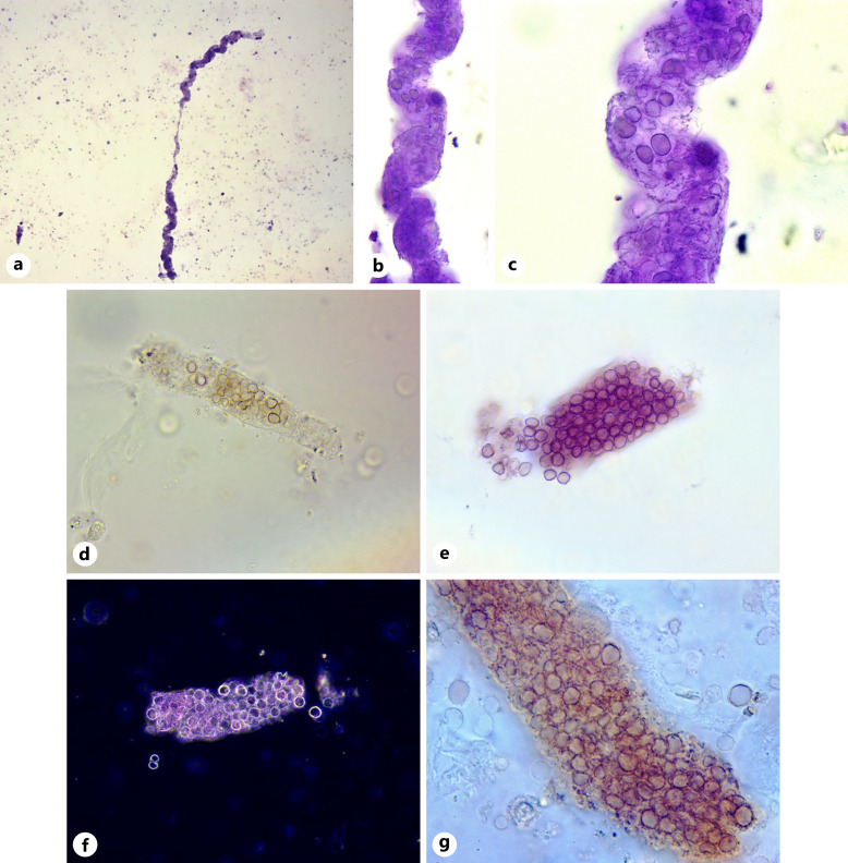 Glomerular Hematuria for the Diagnosis of Glomerulonephritis.