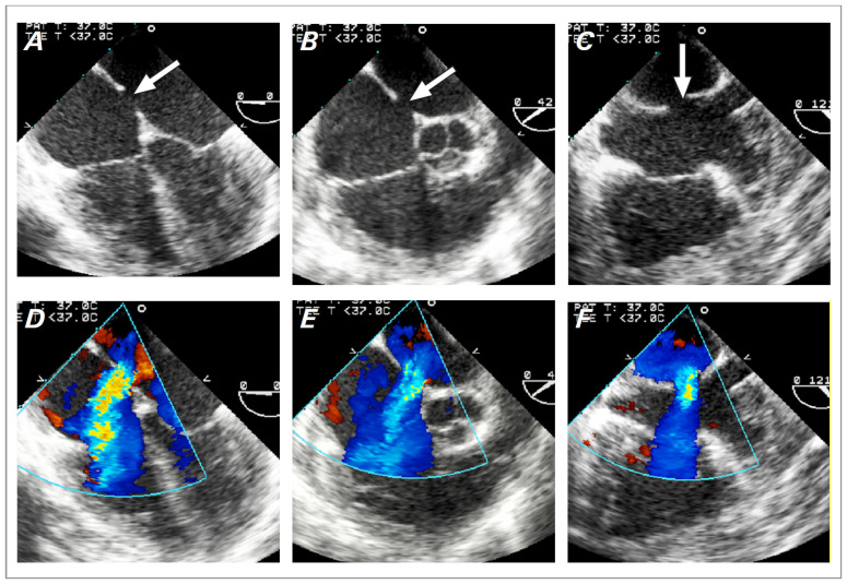 Cardiovascular Imaging of the Left Atrium in Patients With Structural Heart Disease: What Does the Interventionalist Need to Know?