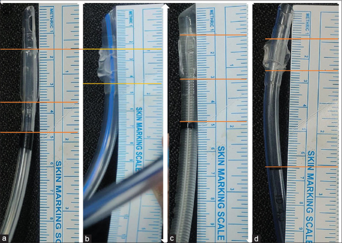 Variation in endotracheal tube length distal to depth marking in pediatrics: A need for standardization.