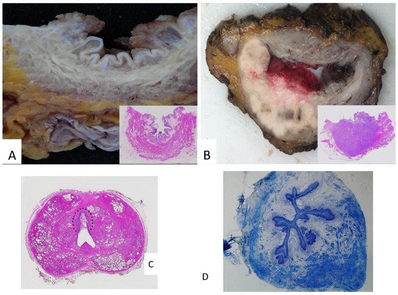 The Handling and Sampling of Radical Cystectomy Specimens: A Standardized Approach for Pathological Evaluation.