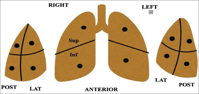 Evaluation of abdominal expiratory muscle thickness pattern, diaphragmatic excursion, diaphragmatic thickness fraction and lung ultrasound score in critically ill patients and their association with weaning patterns: A prospective study.