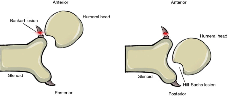 Management of anterior shoulder instability in the contact athlete: a narrative review.