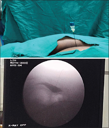 Comparison of radiofrequency thermocoagulation of ganglion Impar with block using a combination of local anaesthetic and steroid in chronic perineal pain.