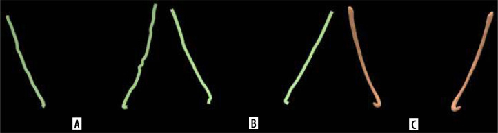 Assessing the accuracy of artificial intelligence in mandibular canal segmentation compared to semi-automatic segmentation on cone-beam computed tomography images.