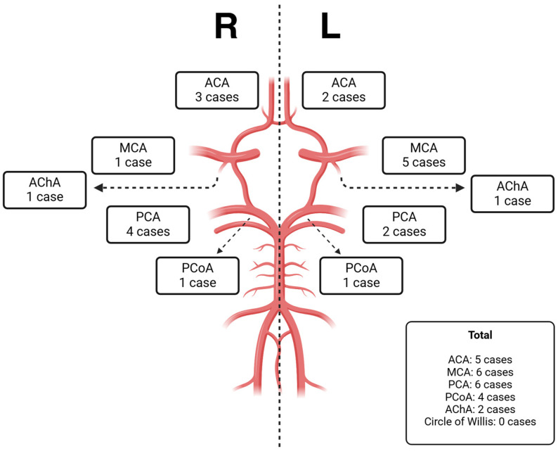 Neonatal Perforator Stroke: Timing, Risk Factors, and Neurological Outcome from a Single-Center Experience.