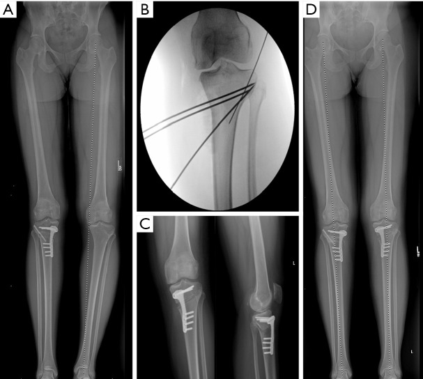 Joint preservation procedures: osteotomies about the knee.