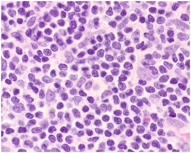 Clinicopathologic features and clinical outcome in a cat with nodal T-zone lymphoma.