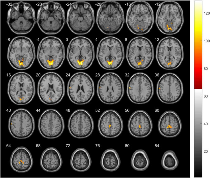 Reduced local functional connectivity correlates with atypical performances in children with autism spectrum disorder.