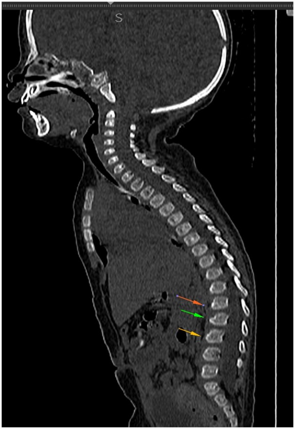 Imaging manifestations in infantile GM1 gangliosidosis: a rare lysosomal storage disorder: a paediatric case report.