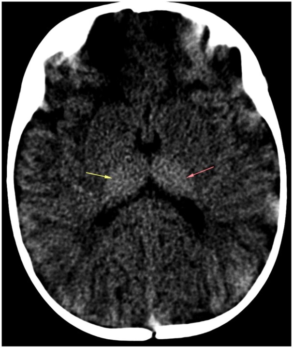 Imaging manifestations in infantile GM1 gangliosidosis: a rare lysosomal storage disorder: a paediatric case report.