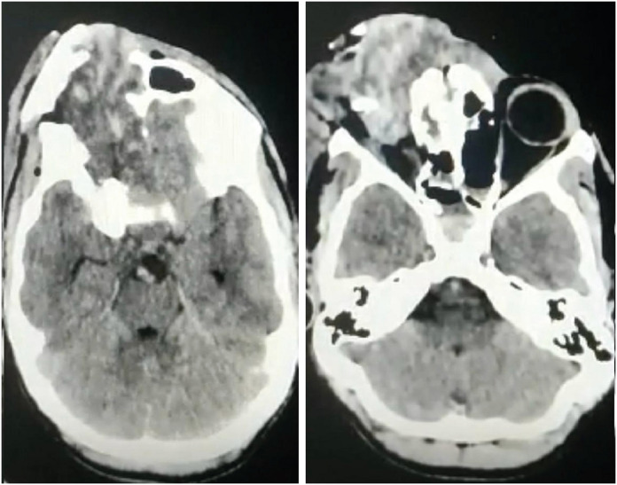 Agricultural Farm-Related Head Injuries in Rural India: A Case Series.