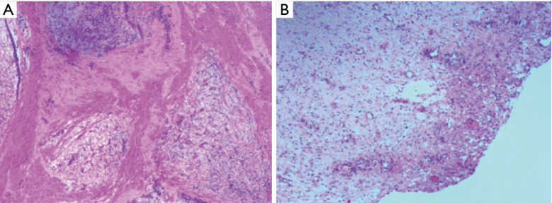 Robot-assisted partial gastrectomy with Billroth I anastomosis for gastric plexiform fibromyxoma in children: the first case report and literature review.