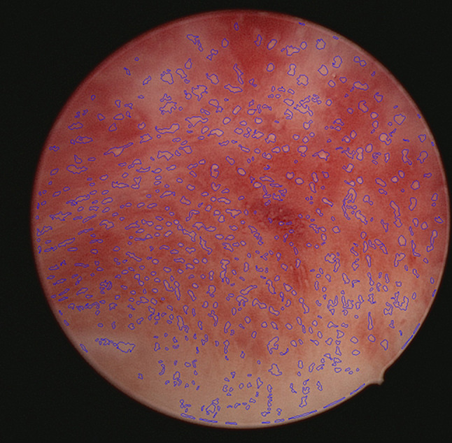 Comparative analysis of endometrial gland imaging and pinopode detection for assessing endometrial receptivity.