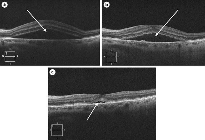 Delayed Onset of Central Serous Chorioretinopathy following Corticosteroid Treatment for Giant Cell Arteritis: A Case Report.