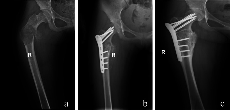 Feasibility of non-radical resection combined with internal fixation for adolescents with lower limb fibrous dysplasia: a single-center retrospective study with a small sample size.