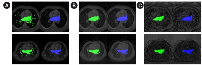 Comparative evaluation of deep learning architectures, including UNet, TransUNet, and MIST, for left atrium segmentation in cardiac computed tomography of congenital heart diseases.