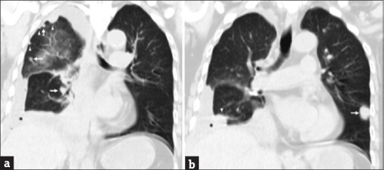 Pulmonary tumor with osteosarcomatous and chondrosarcomatous components: The differential diagnosis.