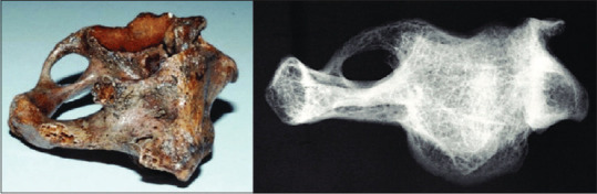 Exploring the prevalence and impact on craniocervical spine surgery of ponticulus posticus on atlas lamina thickness.