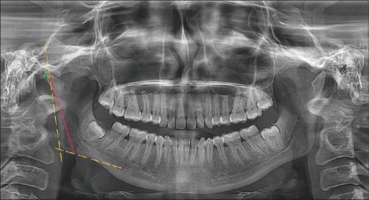 Prediction of gender from radiographic condylar and coronoid measurements using elastic net and random forests.