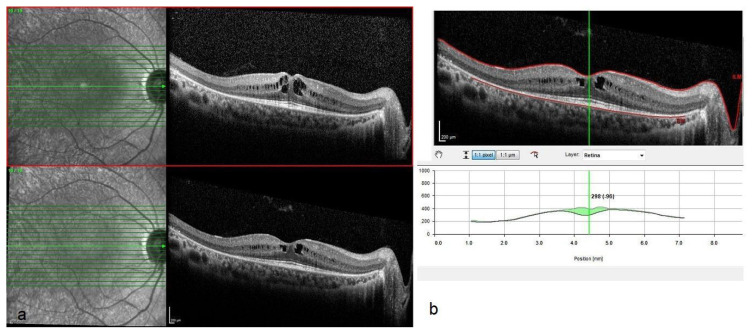 Short-term efficacy and safety of nondamaging retinal laser therapy for retinitis pigmentosa-associated cystoid macular edema.