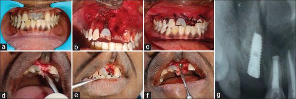 Histomorphometric evaluation of chitosan and concentrated growth factor reinforced bone following cystectomy - A case control study.