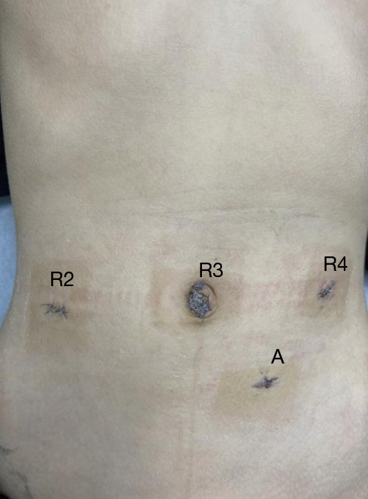 Robot-assisted partial gastrectomy with Billroth I anastomosis for gastric plexiform fibromyxoma in children: the first case report and literature review.