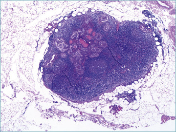 Evaluation of papillary thryoid carcinoma and its variants: multifocality in thyroid lobectomy and completion thyroidectomy - a single tertiary center retrospective study.