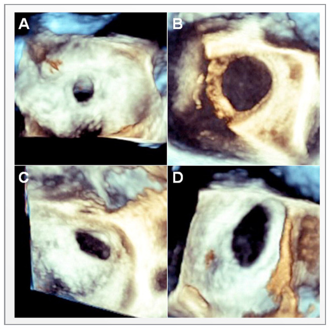 Cardiovascular Imaging of the Left Atrium in Patients With Structural Heart Disease: What Does the Interventionalist Need to Know?