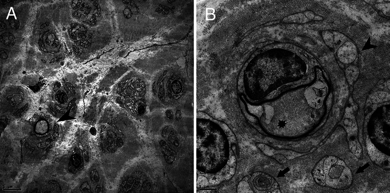 Genetic and clinical spectrum of early growth response 2-related Charcot-Marie-Tooth disease in a Brazilian cohort.