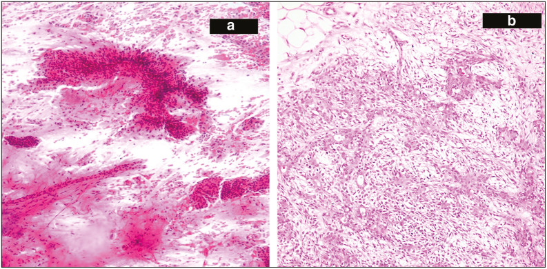 Intraoperative Decision-Making: A Comparative Analysis of Scrape Cytology vs. Frozen Section in Eighty Consecutive Samples.