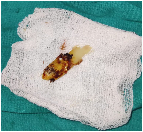 Chronic Rib Osteomyelitis in a Young Adult Female: Diagnostic Challenges and Implications of a Rare Case in a Resource-Limited Setting.