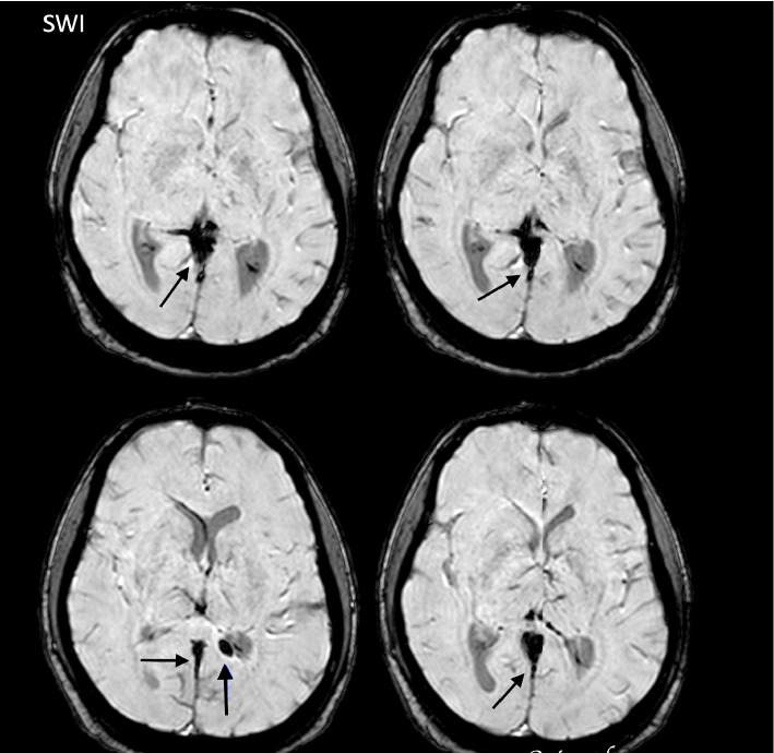 Exploring Central Venous Thrombosis as a Rare Postinfectious Complication of Dengue: A Case Report.