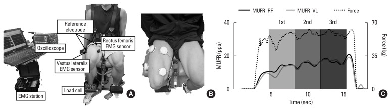 Effects of neuromuscular electrical stimulation on neuromuscular function and muscle quality in patient following anterior cruciate ligament reconstruction.