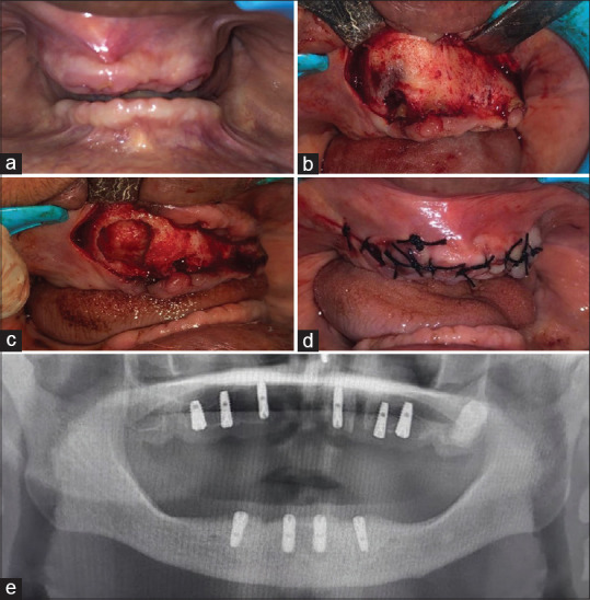 Histomorphometric evaluation of chitosan and concentrated growth factor reinforced bone following cystectomy - A case control study.