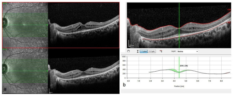 Short-term efficacy and safety of nondamaging retinal laser therapy for retinitis pigmentosa-associated cystoid macular edema.