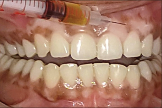 Vitamin C as a probable inhibitor of tyrosinase (Tyr) and tyrosinase-related protein-1 (TRP-1) in human gingiva: An analytical study.