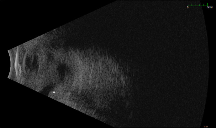Aqueous Humor Liquid Biopsy to Exclude Retinoblastoma for a Child with an Intraocular Mass.