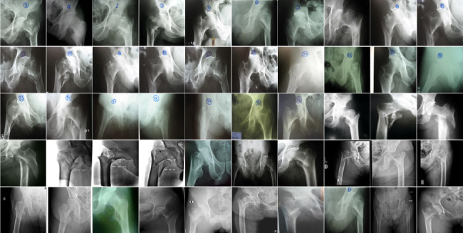 TROCHANTERIC FRACTURES: ARE THE CLASSIFICATIONS RELIABLE?
