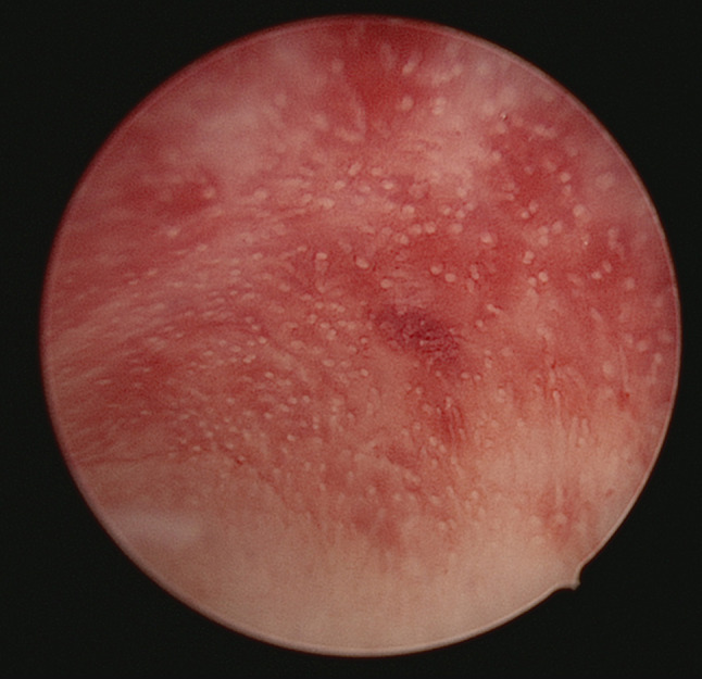 Comparative analysis of endometrial gland imaging and pinopode detection for assessing endometrial receptivity.