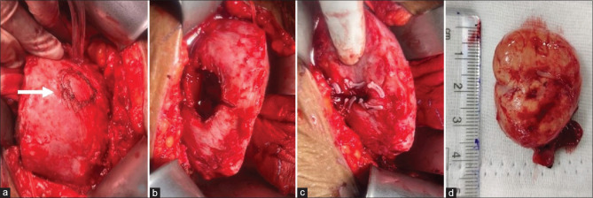 Partial nephrectomy for a completely endophytic tumor in an allograft kidney, 14 years after transplantation.