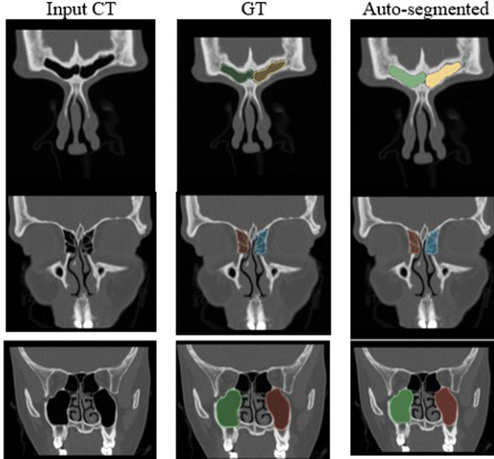 The use of a convolutional neural network to automate radiologic scoring of computed tomography of paranasal sinuses.
