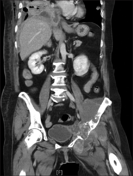 Pulmonary tumor with osteosarcomatous and chondrosarcomatous components: The differential diagnosis.