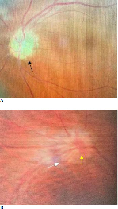 Foster Kennedy Syndrome from Frontal Lobe Meningioma: A Rare Case Report.