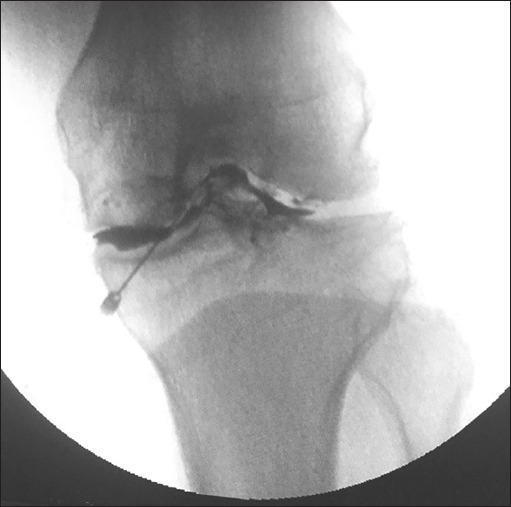 Comparison of intra-articular injection of platelet-rich plasma with combination of bupivacaine and corticosteroid in osteoarthritis knee.