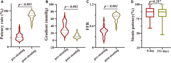 Pulmonary Artery Stent Implantation for Fibrosing Mediastinitis: Our Clinical Experience.