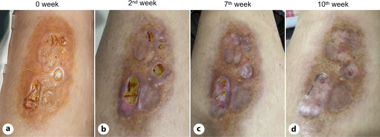 Successful Treatment of Necrobiosis Lipoidica with Abrocitinib: A Case Report.