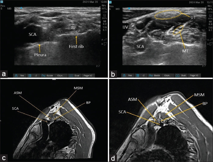 Anatomical variation in the relationship between brachial plexus and subclavian artery visualized on ultrasound while performing supraclavicular brachial plexus block.