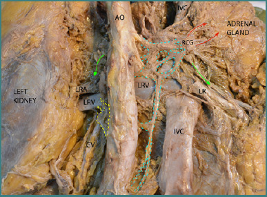 The dissection-based identification of the preaortic sympathetic plexus formation, anatomical relations, and clinical applications.